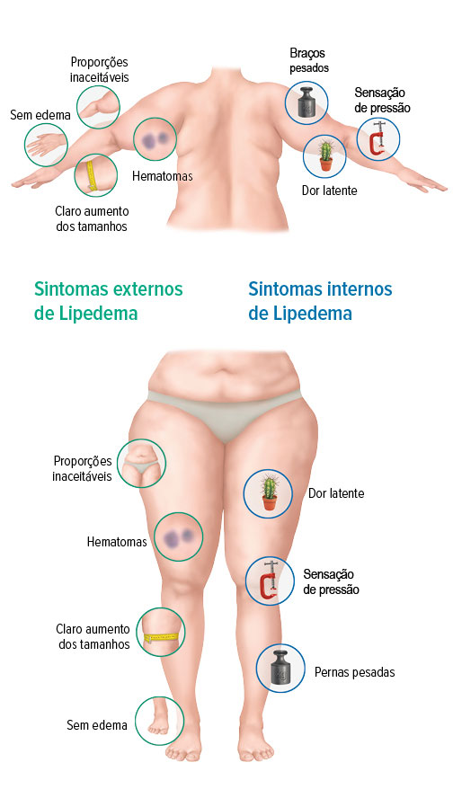 sintomas externos e internos de lipedema (edema)
